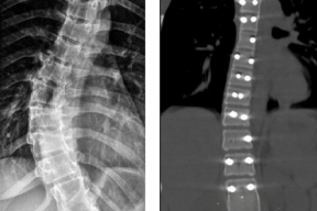 Нейрохирурги Ставрополя провели уникальную операцию пациентке с изгибом позвоночника в 40 градусов